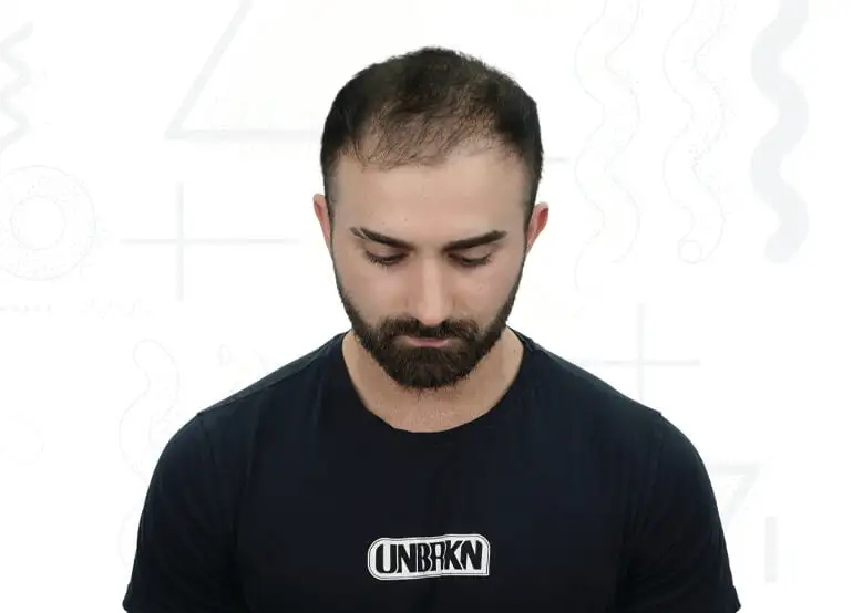 Protez Saç Öncesi